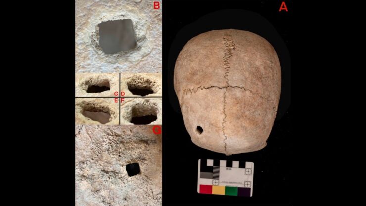 Nail hole in the skull of a woman buried face down in the 3rd century BC.